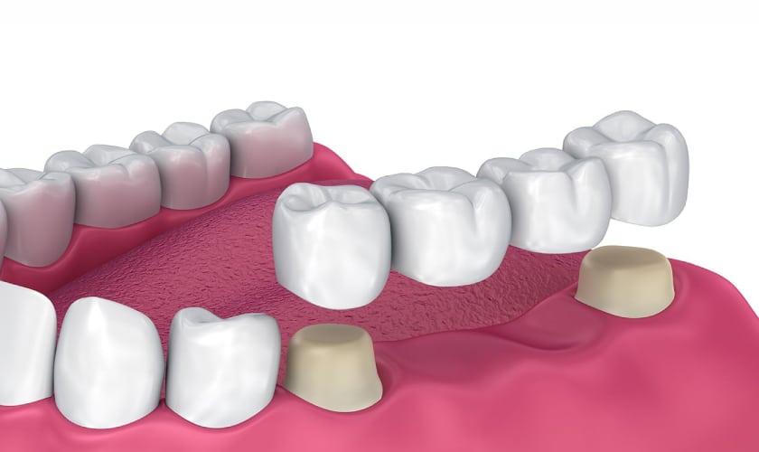 dental bridge